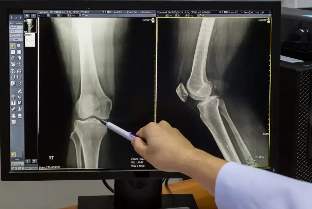 doctor examine X-ray for potential knee replacement