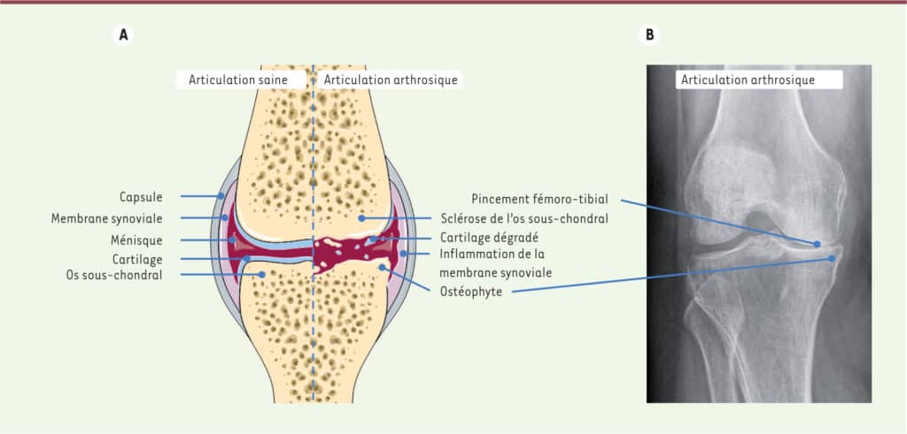 Diagnosis of knee osteoarthritis diagram